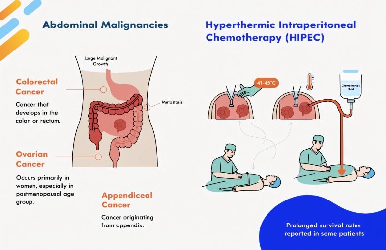 hipec surgery mohali cytoreductive peritoneal cancer